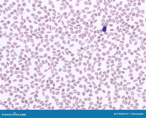 The Life Span of the Elliptocyte : Hereditary Elliptocytosis and Its .